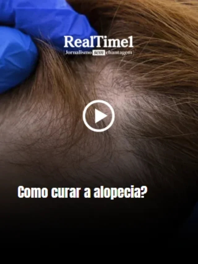 alopecia