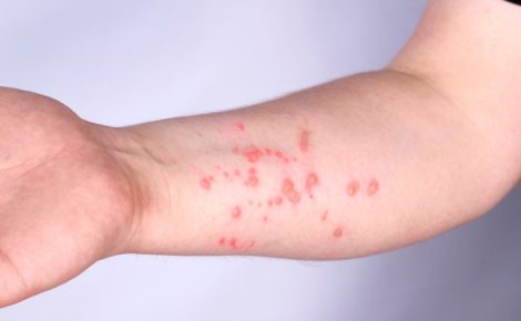 O Amazonas não registrou novos casos de Mpox na última semana. (Foto: Getty Images)