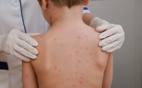Sintomas da meningite. (Foto: Reprodução)