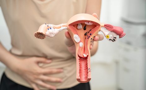 Dia Internacional da Luta Contra a Endometriose, entenda os sintomas e tratamentos da doença.