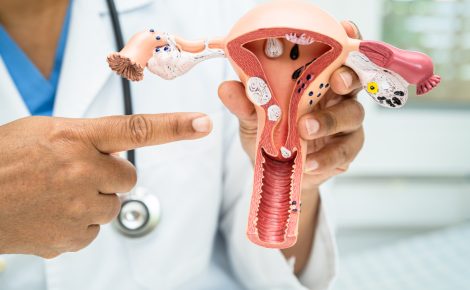 Desde março de 2023, a nova lei permite que mulheres façam laqueadura sem autorização do cônjuge.